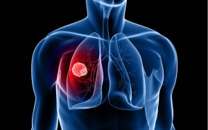 Καρκίνος του πνεύμονα - Νοσ. Φροντίδα