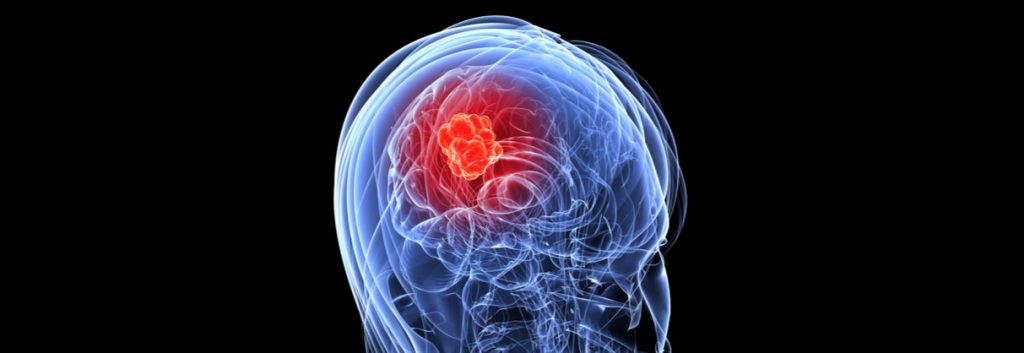 Τι είναι ο όγκος του εγκεφάλου;
