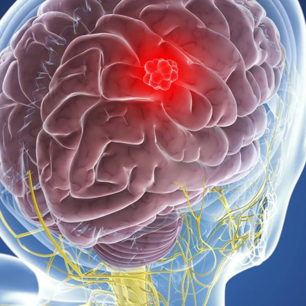 Ποιοί είναι οι τύποι πρωτοπαθών όγκων εγκεφάλου; Ποιά είναι τα συμπτώματα;Τι πρέπει να γνωρίζετε για το μηνιγγίωμα; Αιτίες - Συμπτώματα
