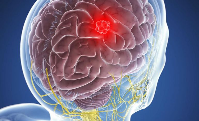 Ποιοί είναι οι τύποι πρωτοπαθών όγκων εγκεφάλου; Ποιά είναι τα συμπτώματα;
