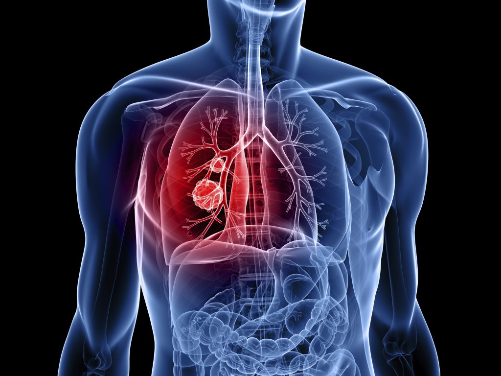 Υπάρχει σχέση μεταξύ ΧΑΠ και καρκίνου του πνεύμονα; Ποιοι είναι οι τύποι καρκίνου του πνεύμονα;