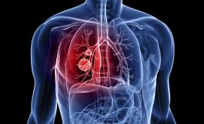 Υπάρχει σχέση μεταξύ ΧΑΠ και καρκίνου του πνεύμονα;